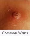 Common Warts