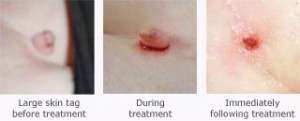 Skin Tags before, during and after treatment